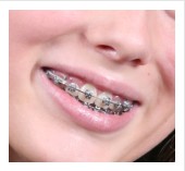 Types of Braces