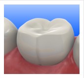 Composite Fillings 